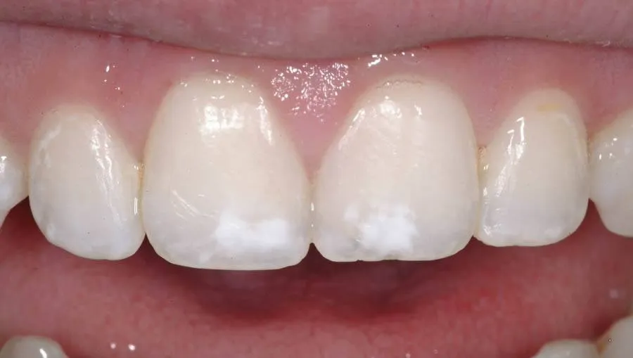 Patient C before treatment