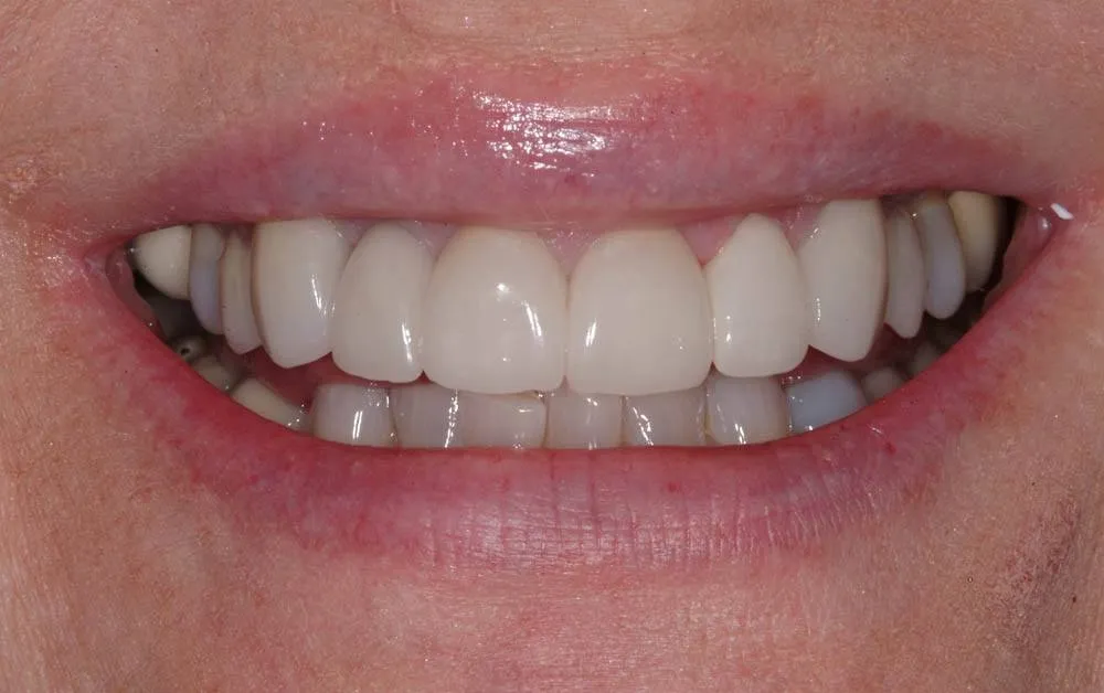 Patient D after treatment