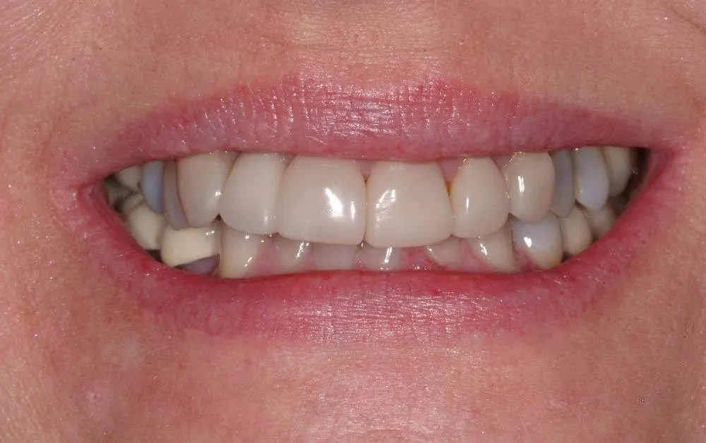 Patient D before treatment