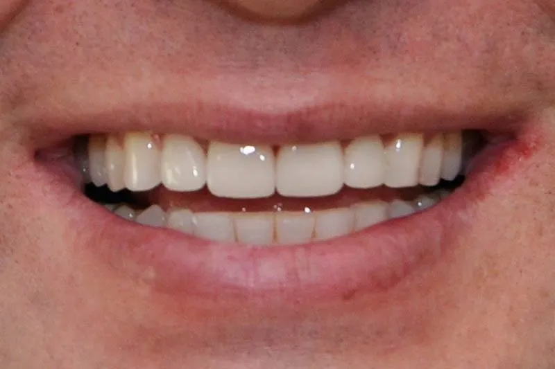 Patient E after treatment