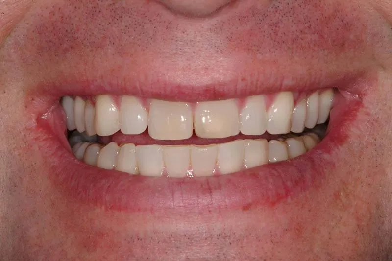 Patient E before treatment