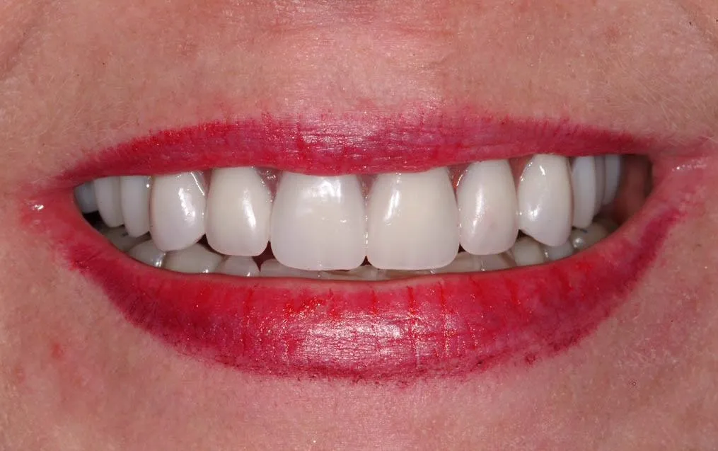 Patient F after treatment