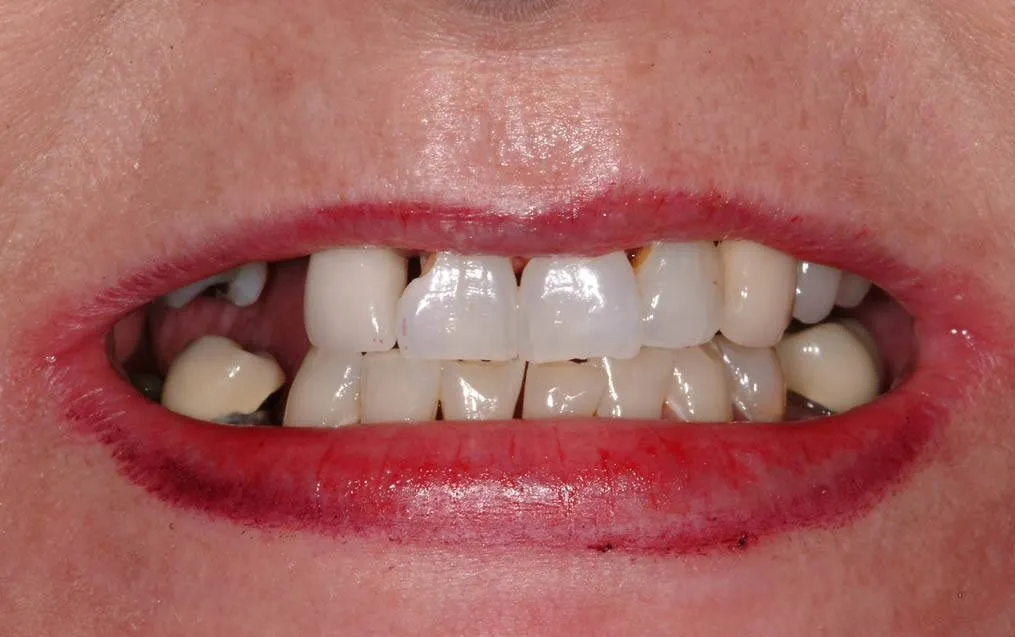 Patient F before treatment