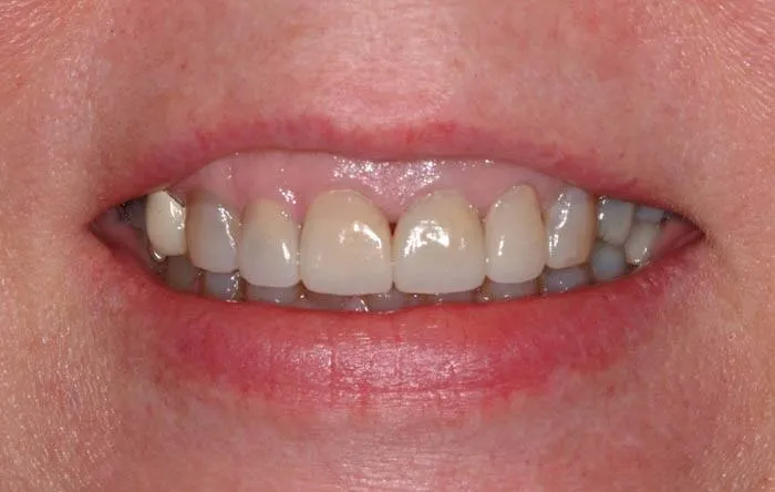 Patient G after treatment