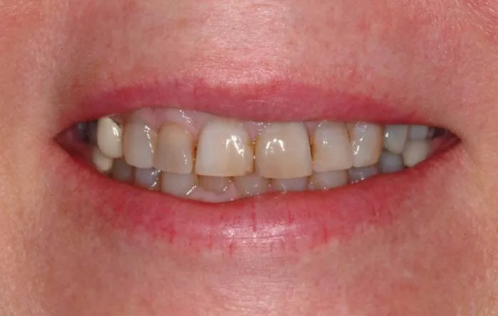 Patient G before treatment