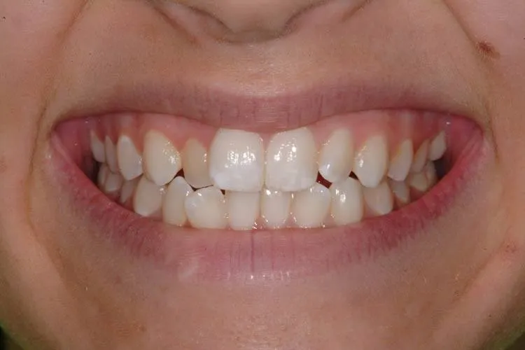 Patient H before treatment