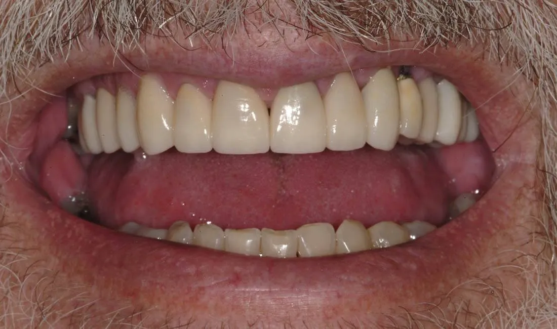 Patient I after treatment