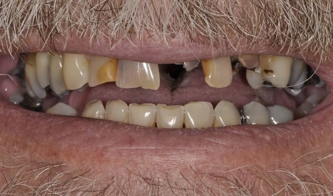 Patient I before treatment