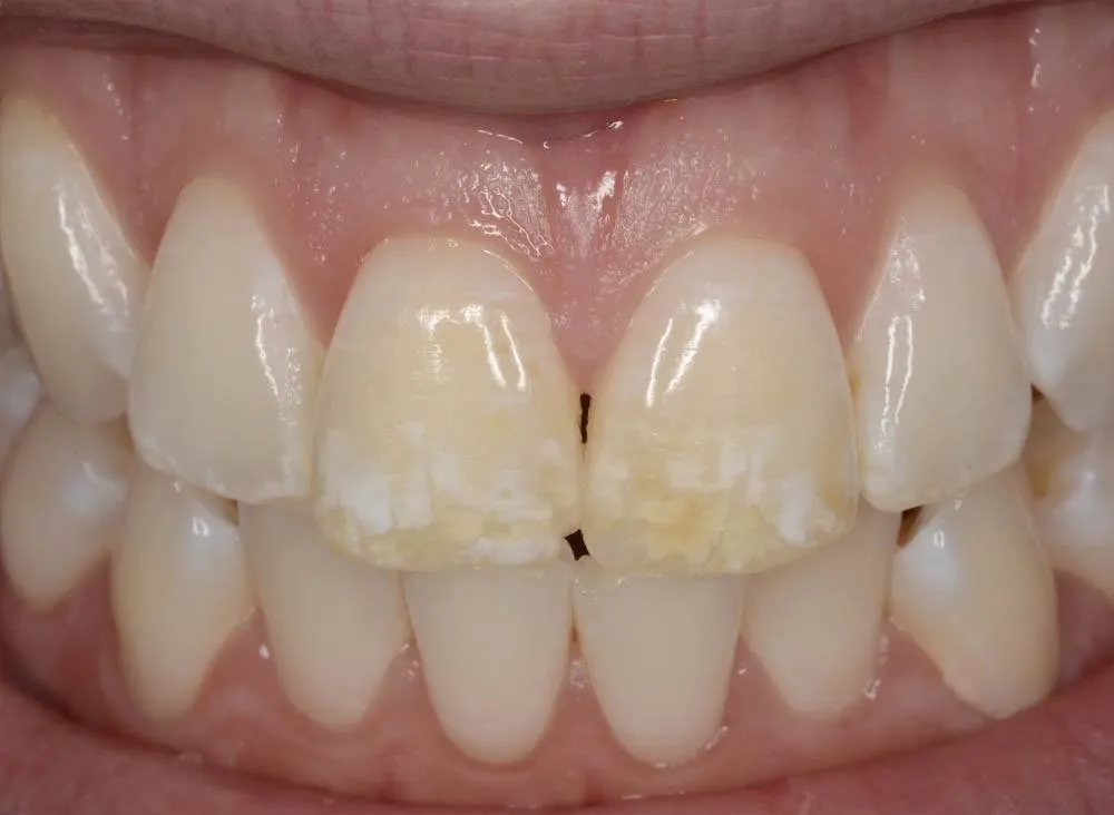 Patient J before treatment