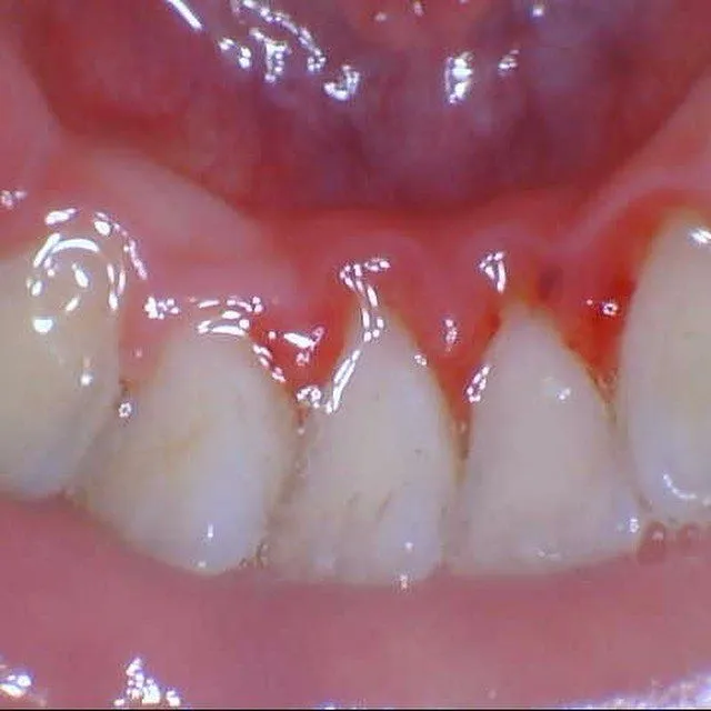 Patient K after treatment