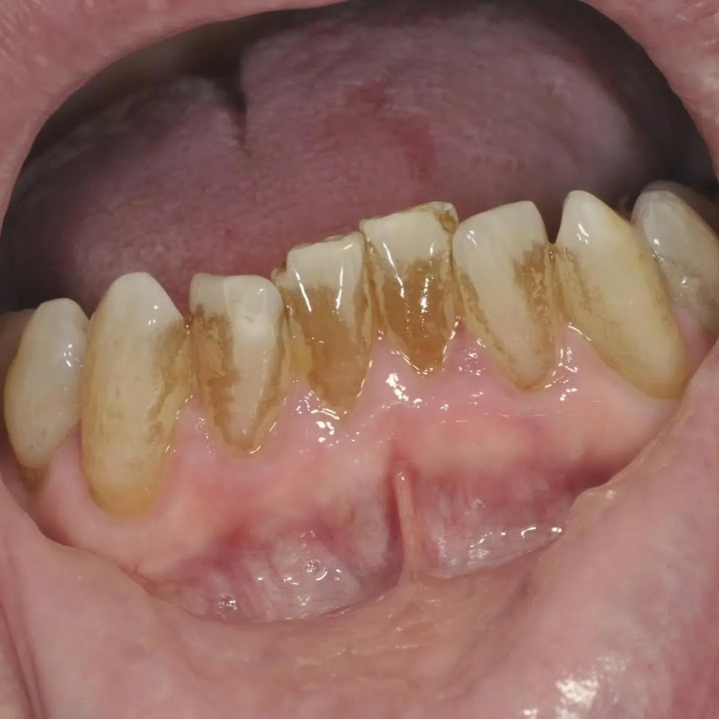 Patient L before treatment