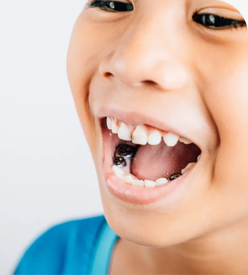 Dental Sealants in Layton, UT: A Practical Guide