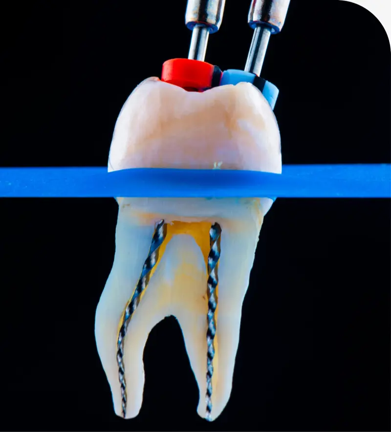 Root Canal Therapy in Layton, UT